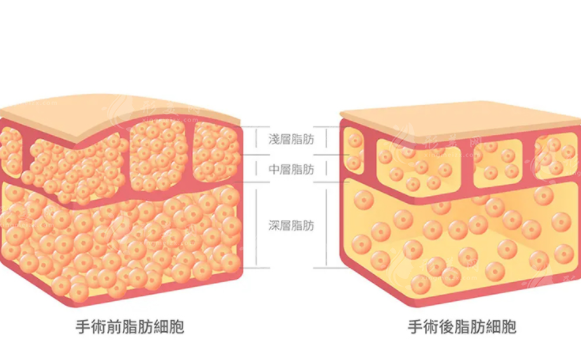 背部吸脂的常識(shí)有哪些？有風(fēng)險(xiǎn)和并發(fā)癥嗎？