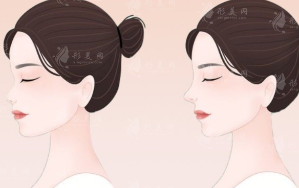 「漲點(diǎn)姿勢(shì)」亞洲人應(yīng)該怎樣做鼻整形手術(shù)？