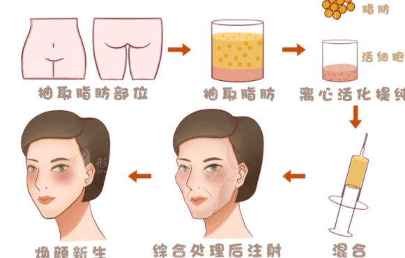 脂肪填充過量怎樣修復？手術(shù)方法一覽