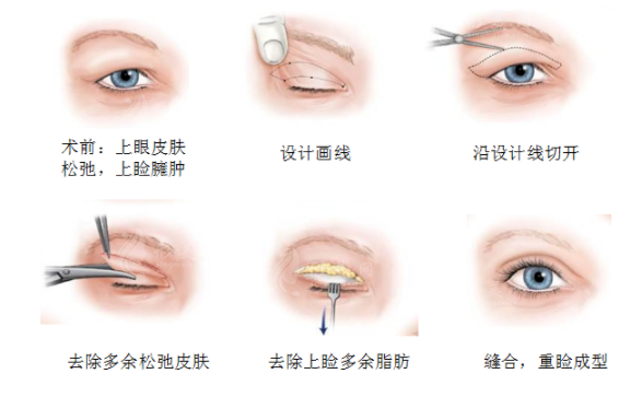 疤痕體質(zhì)可以割雙眼皮嗎？術(shù)前要考慮哪些因素？
