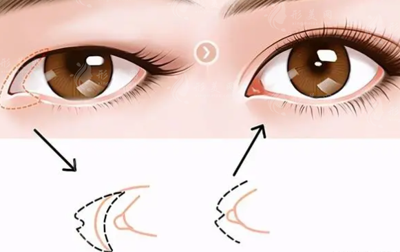 開眼角和割雙眼皮應(yīng)該一起做好還是分開做好？