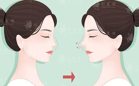鼻子假體能永久帶嗎？下面我們一起來看看吧