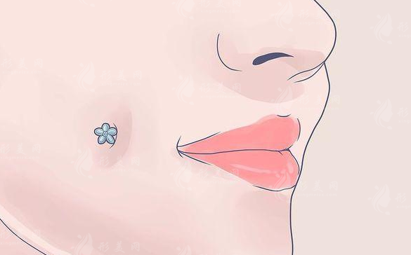酒窩切開(kāi)恢復(fù)期要多長(zhǎng)？恢復(fù)期間注意什么？