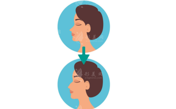 什么是自體筋膜隆鼻？手術(shù)包括哪些步驟？