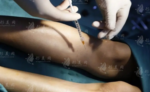 o型腿自體脂肪填充恢復(fù)期是多久？