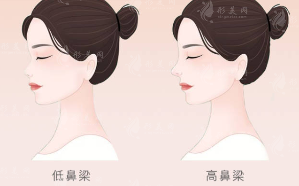 膨體隆鼻有后遺癥嗎？出現(xiàn)以下情況要注意