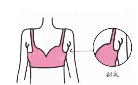 副乳切除是選擇微創(chuàng)還是開刀？