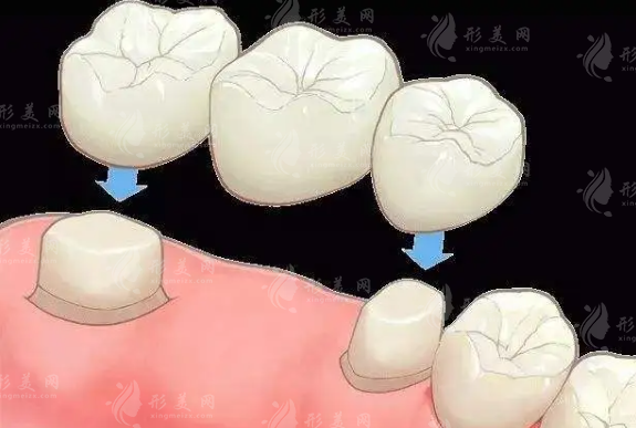 成都烤瓷牙多少錢一顆價格表2023更新！本地人收藏~