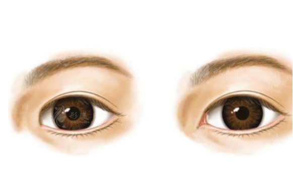 開(kāi)眼角手術(shù)安全嗎？需要注意什么呢？