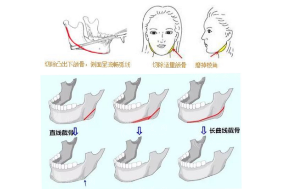 上海華美整形醫(yī)院地址，24小時(shí)免費(fèi)咨詢預(yù)約，了解磨骨豐胸價(jià)格