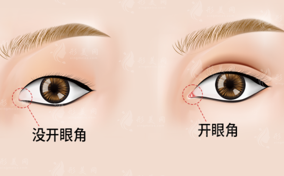 開(kāi)眼角不當(dāng)影響眼睛閉合嗎？開(kāi)眼角手術(shù)要注意什么？