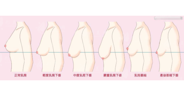 上海仁濟醫(yī)院整形外科胸部整形