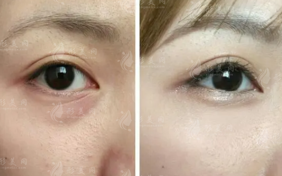 去眼袋術后導致下瞼外翻的原因是什么？怎么進行修復呢？