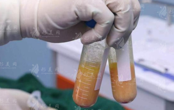 大腿吸脂要分多次進(jìn)行嗎？大腿吸脂后多久可以正常外出？