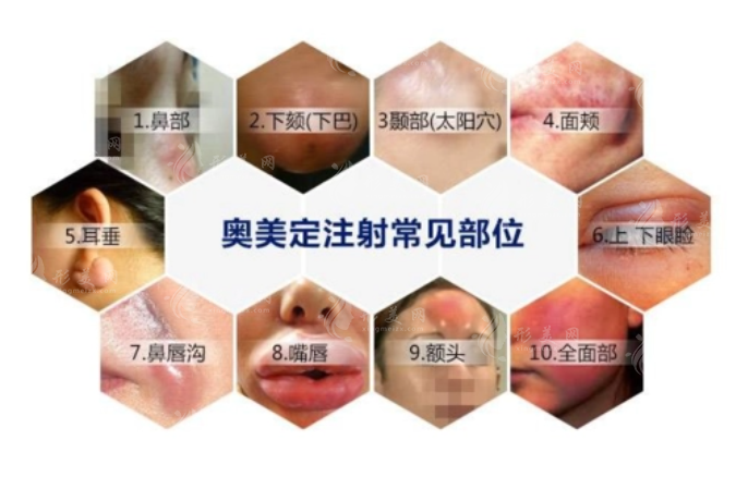 上海九院取奧美定需要多少錢？哪個(gè)醫(yī)生好？不同部位價(jià)格不一樣