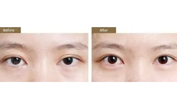 雙眼皮修復(fù)的方案有幾種？恢復(fù)期長嗎？難度大不大？