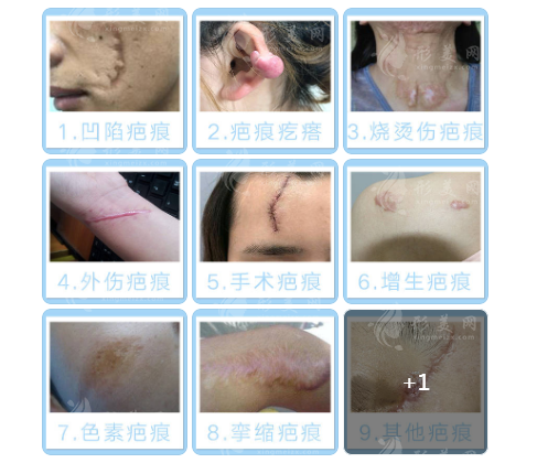 成都友誼醫(yī)院疤痕科開展項(xiàng)目