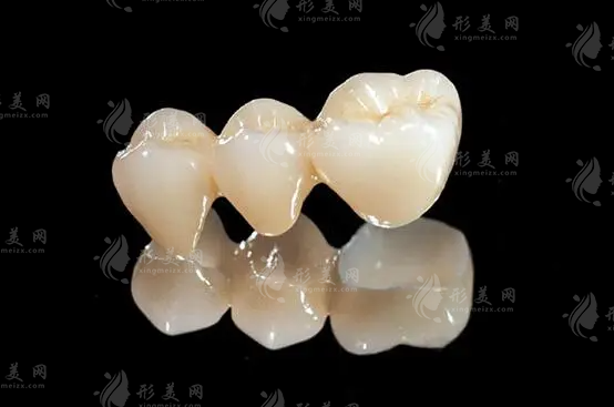 上海九院烤瓷牙價(jià)格是多少？效果怎么樣？全新收費(fèi)標(biāo)準(zhǔn)來襲！