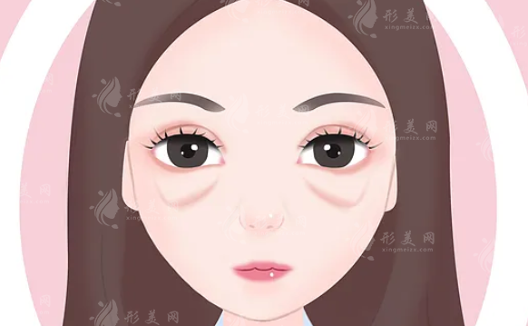 去眼袋失?。繉?duì)應(yīng)不同情況，眼袋修復(fù)手術(shù)讓你找回本屬于自己的美！