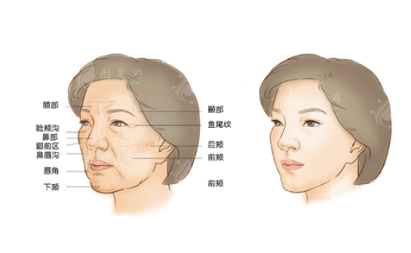 深圳藝星整形脂肪填充怎么樣？醫(yī)生名單一覽、案例分享、附價格表