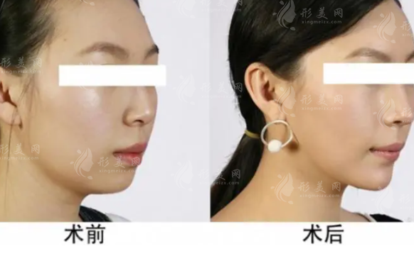 自體脂肪豐下巴缺點(diǎn)有哪些？有副作用嗎？