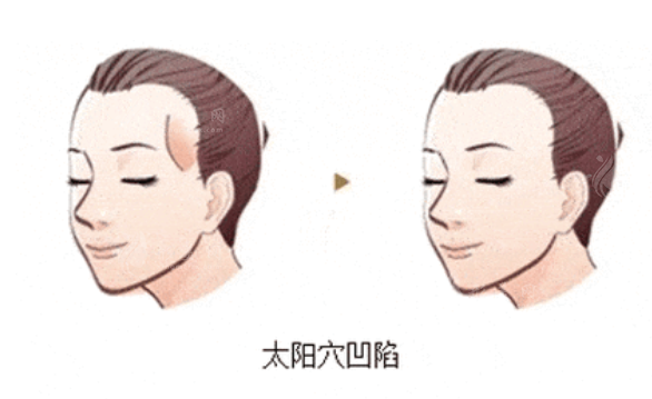 太陽穴凹陷填充方法有哪些？各自優(yōu)勢有哪些？
