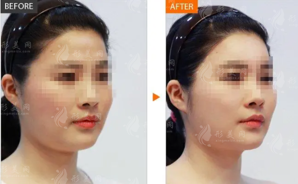 玻尿酸豐額頭的效果怎么樣呢？有沒(méi)有后遺癥嗎？