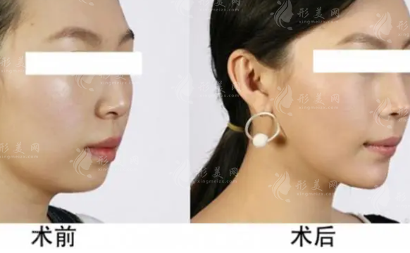 自體脂肪豐下巴是永久的嗎？需要多少錢？