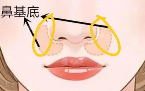 鼻基底填充玻尿酸有什么后遺癥？效果