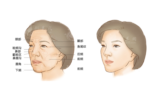 面部填充價(jià)格多少？根據(jù)不同的填充材料，價(jià)格波動(dòng)也很大