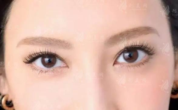 哪些情況下需要做雙眼皮修復(fù)？雙眼皮過寬怎么辦呢？