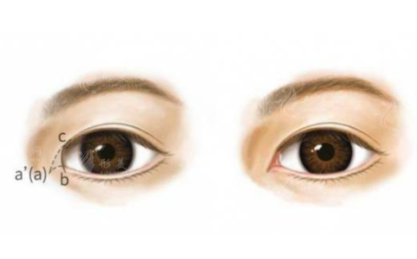內(nèi)眥贅皮一定要開眼角嗎？收費價格貴嗎？