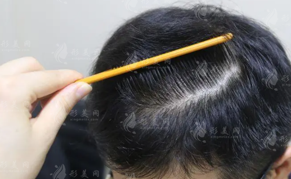 做完植發(fā)手術(shù)后多久可以上班？植發(fā)后可以染燙嗎？