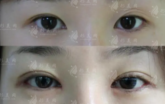 什么樣的雙眼皮需要被修復(fù)？如何修復(fù)呢？