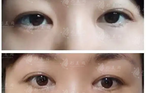 內(nèi)眥贅皮術(shù)會留疤嗎？需要多少錢？