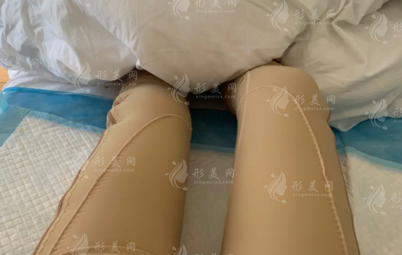 大腿抽脂多久可以看到效果？術(shù)后會(huì)凹凸不平嗎？