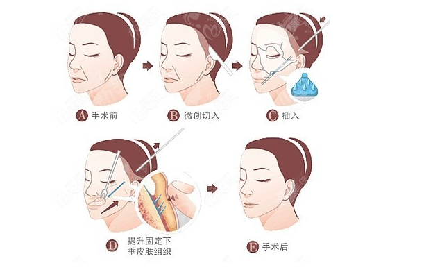 拉皮手術(shù)