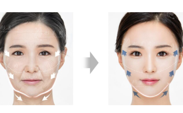 面部提升可以維持多久？有副作用嗎？