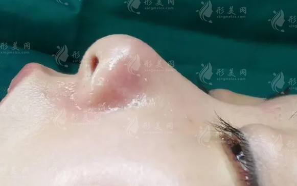 取耳軟骨隆鼻，耳朵會變塌？！耳軟骨隆鼻會被吸收嗎？