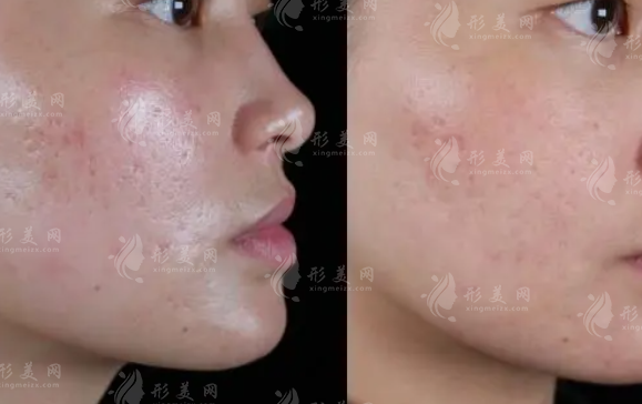 點(diǎn)陣激光祛痘坑多少錢一次？做幾次才有效果？