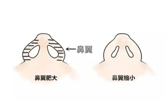 上海九院鼻翼縮小技術(shù)怎么樣？熱門(mén)醫(yī)生介紹+案例分享+收費(fèi)價(jià)格表