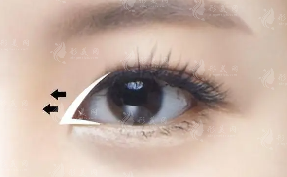 開(kāi)眼角容易留疤、回縮嗎？眼角到底開(kāi)不開(kāi)？