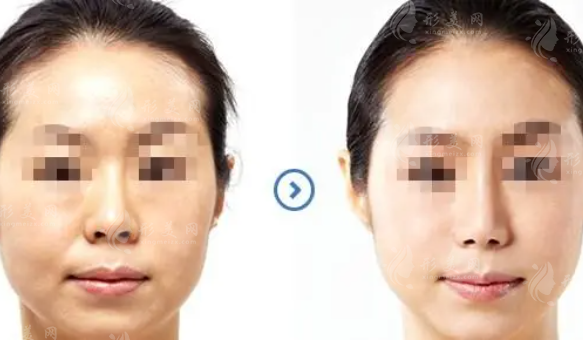 激光除皺手術(shù)有什么優(yōu)勢？激光除皺的原理是什么？