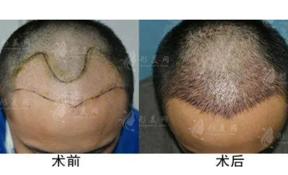 頭發(fā)移植效果能保持多久？手術(shù)有危險(xiǎn)嗎？