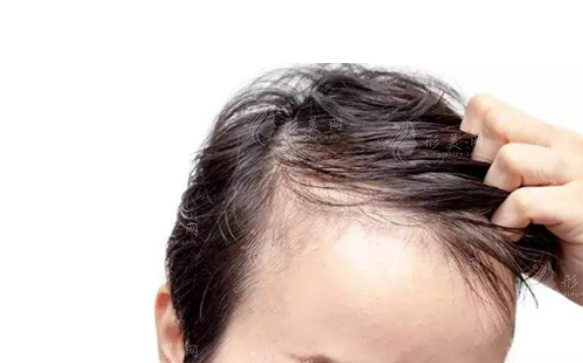 人工植發(fā)一般多少錢？高嗎？