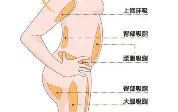 背部吸脂手術(shù)多少錢？手術(shù)效果靠譜嗎？