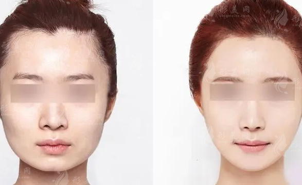 磨骨瘦臉大概多少錢？貴嗎？