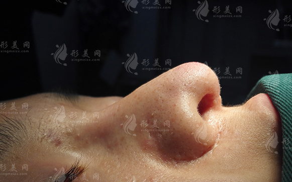 鼻翼缺損矯正大概需要多少錢？會(huì)有副作用嗎？