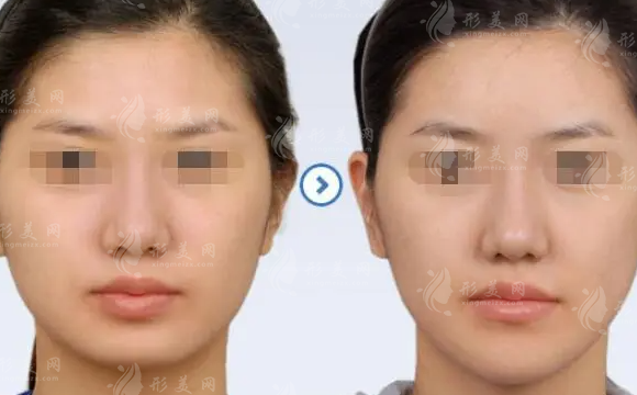 下巴填充玻尿酸能維持多久？有后遺癥嗎？
