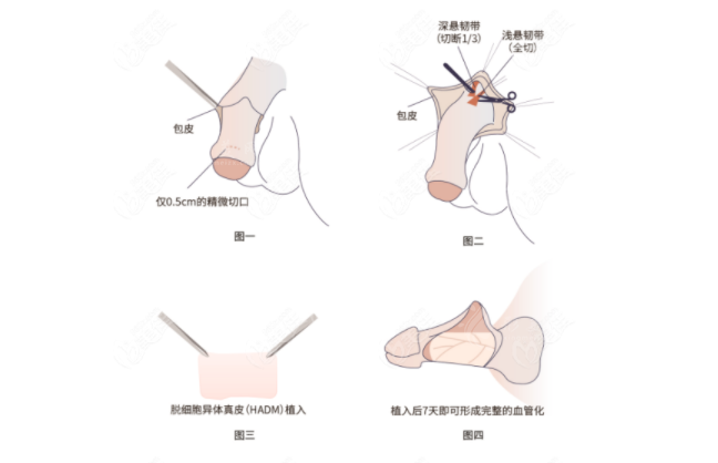 李世榮醫(yī)生做延長(zhǎng)增粗手術(shù)怎么樣？